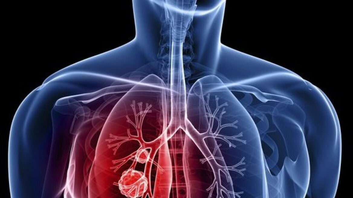 Νέο τεστ αίματος προβλέπει την επανεμφάνιση του καρκίνου των πνευμόνων